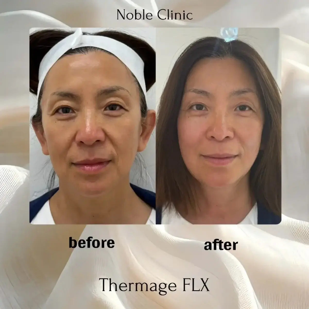 Noble Clinic skin tightening result — Draper, UT