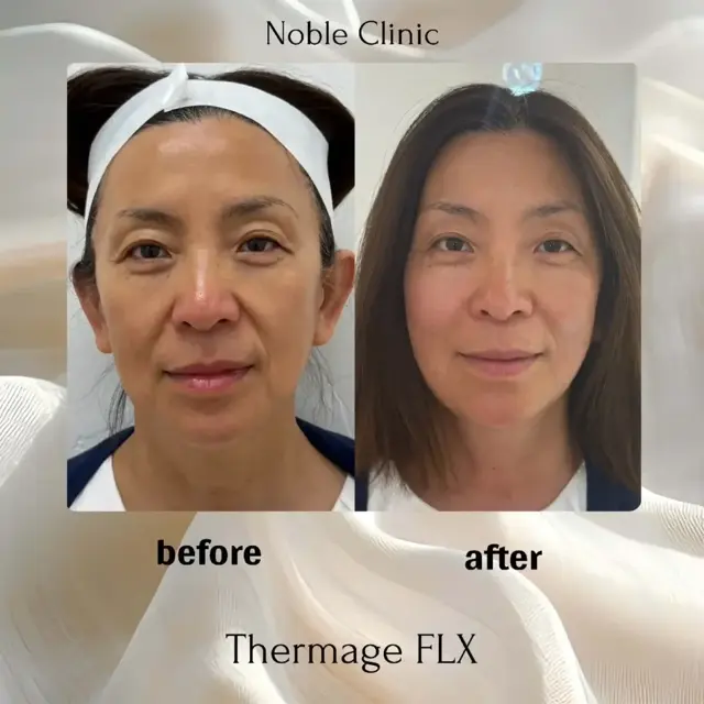 Morpheus8 result at Noble Clinic in Draper, UT