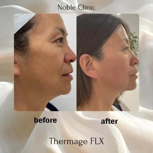 Noble Clinic skin tightening result — Draper, UT