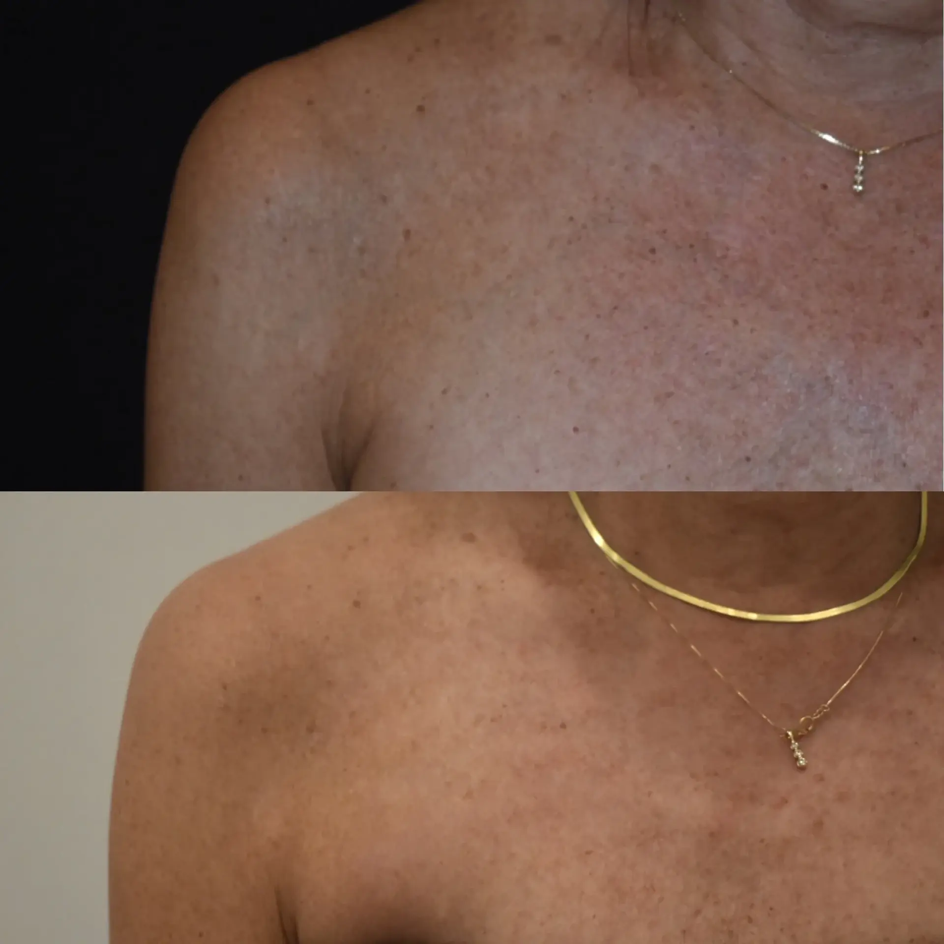 Cosmedics MedSpa photofacial result — Lehi, UT