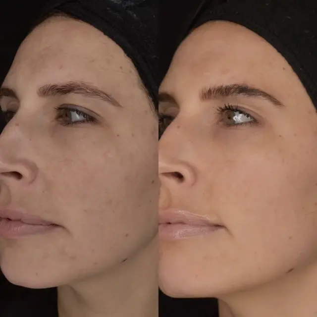 Chemical Peel result at Cosmedics MedSpa in Lehi, UT