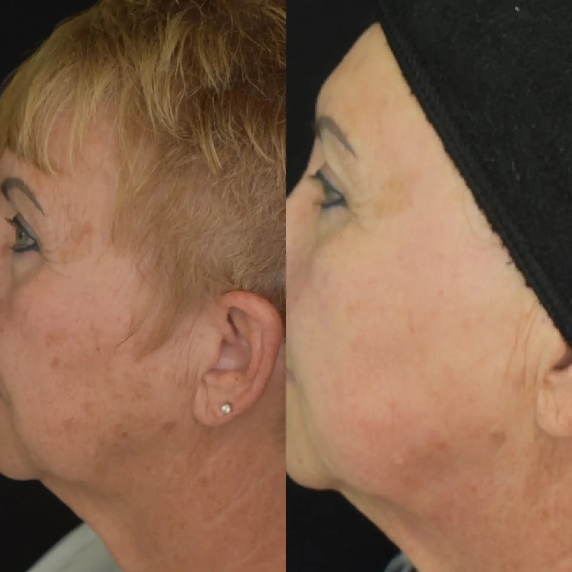 Cosmedics MedSpa photofacial result — Lehi, UT