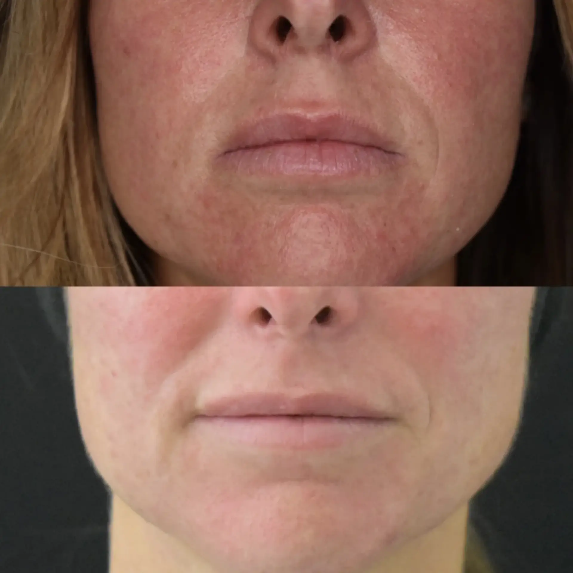 Cosmedics MedSpa photofacial result — Lehi, UT