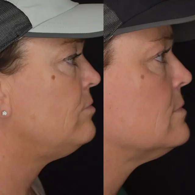 Kybella result at Cosmedics MedSpa in Lehi, UT