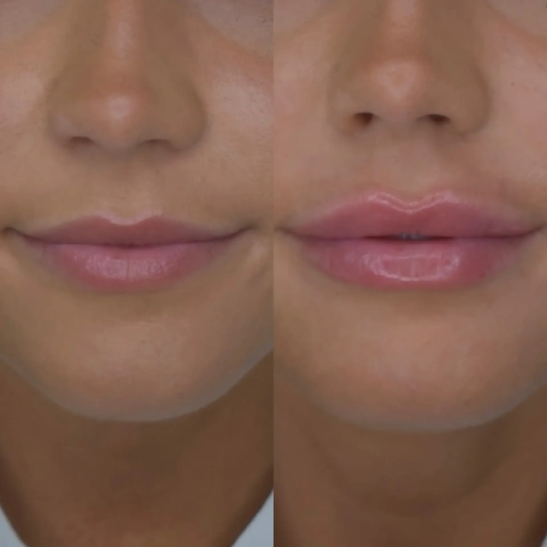 Cosmedics MedSpa lip filler result — Lehi, UT