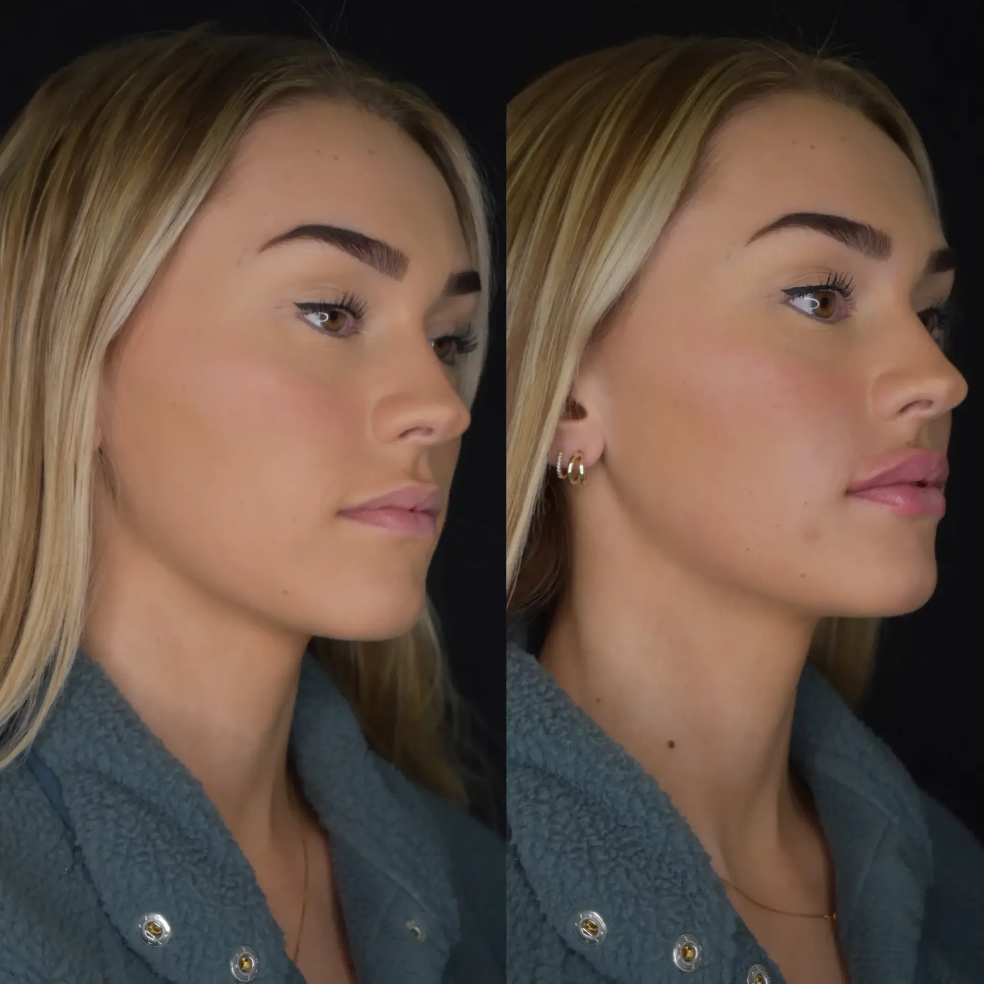 Cosmedics MedSpa lip filler result — Lehi, UT