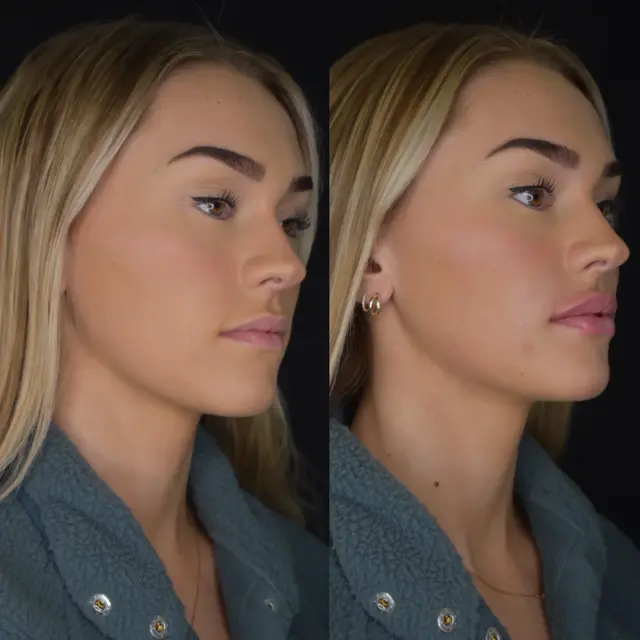 Lip Filler result at Cosmedics MedSpa in Lehi, UT