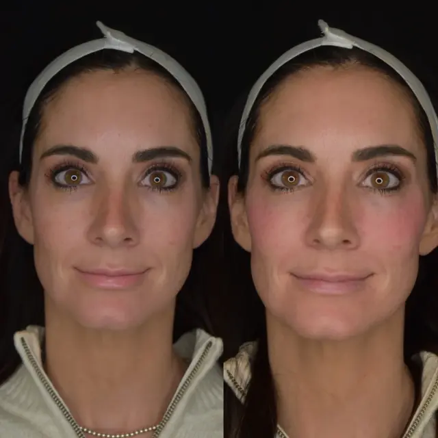 Juvederm result at Cosmedics MedSpa in Lehi, UT