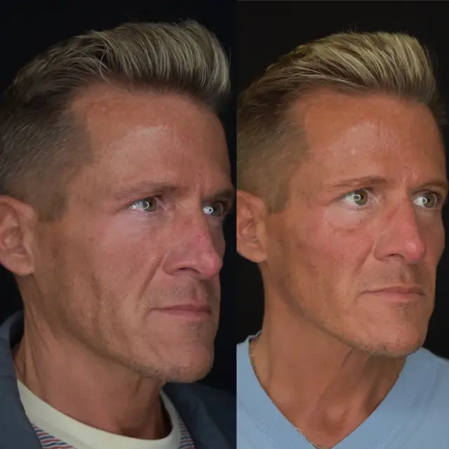 Dermal Fillers result at Cosmedics MedSpa in Lehi, UT