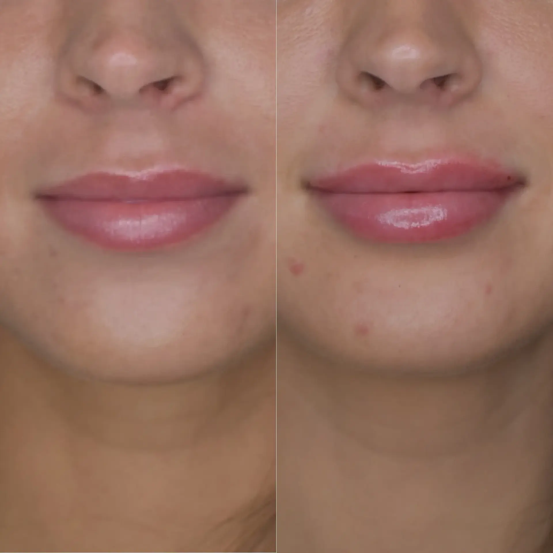 Cosmedics MedSpa lip filler result — Lehi, UT