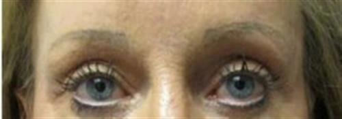 SGK Plastic Surgery brow lift after — The Woodlands, TX