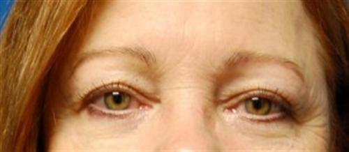 SGK Plastic Surgery eyelid lift after — The Woodlands, TX