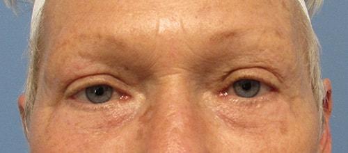 SGK Plastic Surgery eyelid lift after — The Woodlands, TX