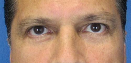 SGK Plastic Surgery eyelid lift after — The Woodlands, TX