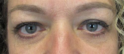 SGK Plastic Surgery eyelid lift after — The Woodlands, TX