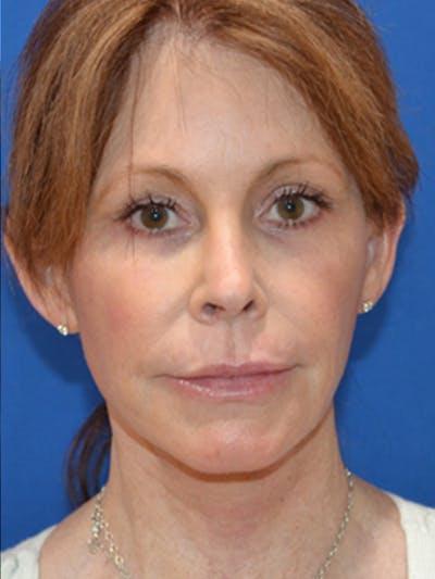 Moradi MD Cosmetic Surgery after — Vista, CA