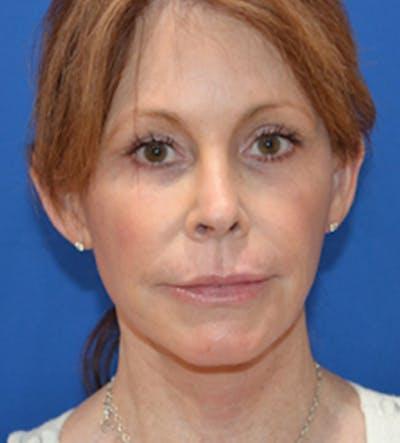 Moradi MD Cosmetic Surgery after — Vista, CA