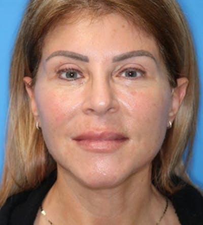 Moradi MD Cosmetic Surgery after — Vista, CA