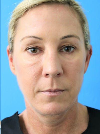 Moradi MD Cosmetic Surgery after — Vista, CA
