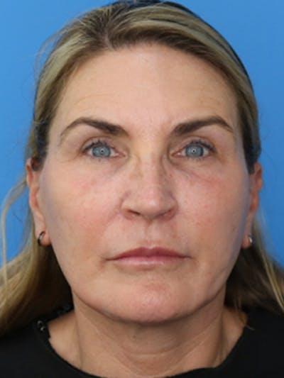 Moradi MD Cosmetic Surgery after — Vista, CA