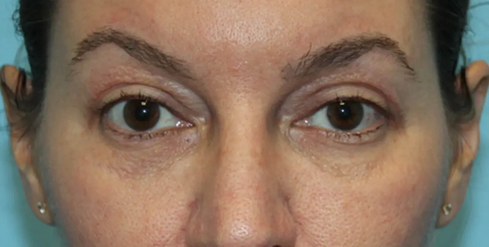 Moradi MD Cosmetic Surgery eyelid lift after — Vista, CA