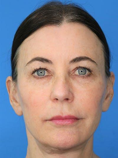 Moradi MD Cosmetic Surgery after — Vista, CA