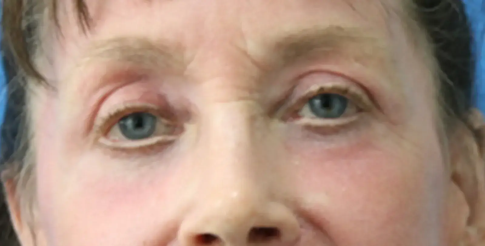 Moradi MD Cosmetic Surgery eyelid lift after — Vista, CA