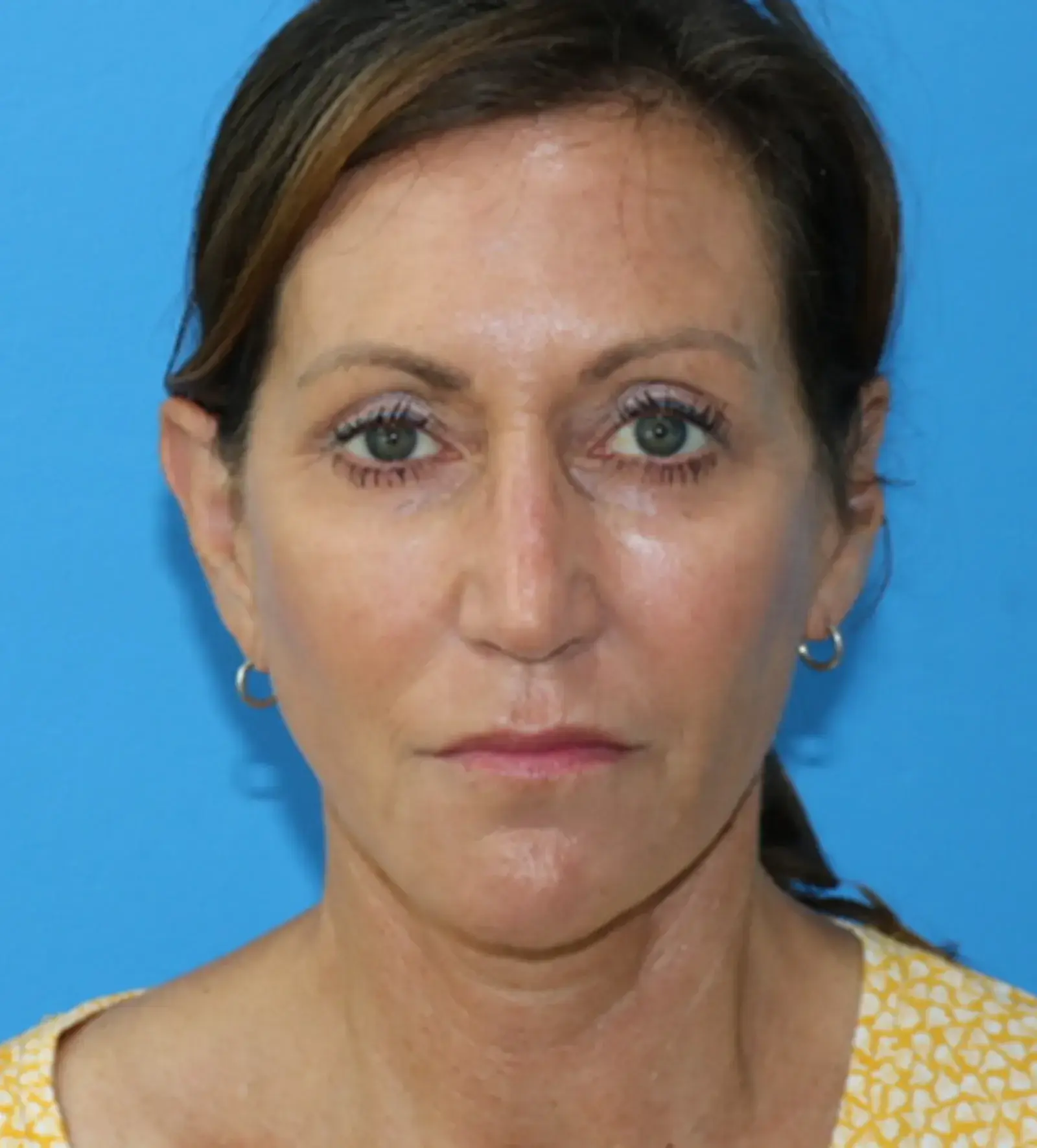 Moradi MD Cosmetic Surgery facelift after — Vista, CA