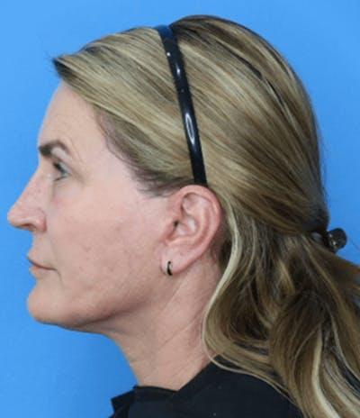 Moradi MD Cosmetic Surgery after — Vista, CA