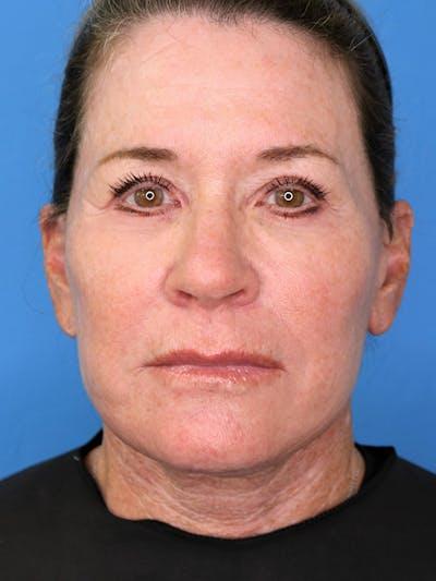 Moradi MD Cosmetic Surgery after — Vista, CA