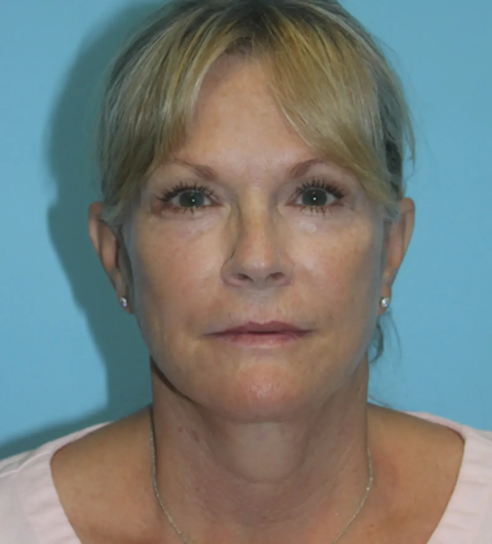 Moradi MD Cosmetic Surgery facelift after — Vista, CA