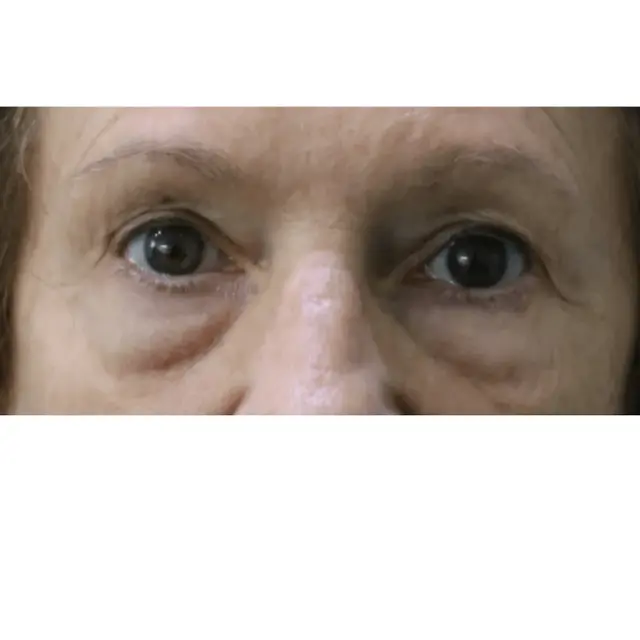 Blepharoplasty before at Moradi MD Cosmetic Surgery in Vista, CA