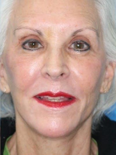 Moradi MD Cosmetic Surgery after — Vista, CA