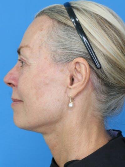 Moradi MD Cosmetic Surgery after — Vista, CA