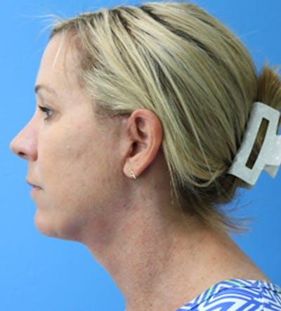 Moradi MD Cosmetic Surgery after — Vista, CA