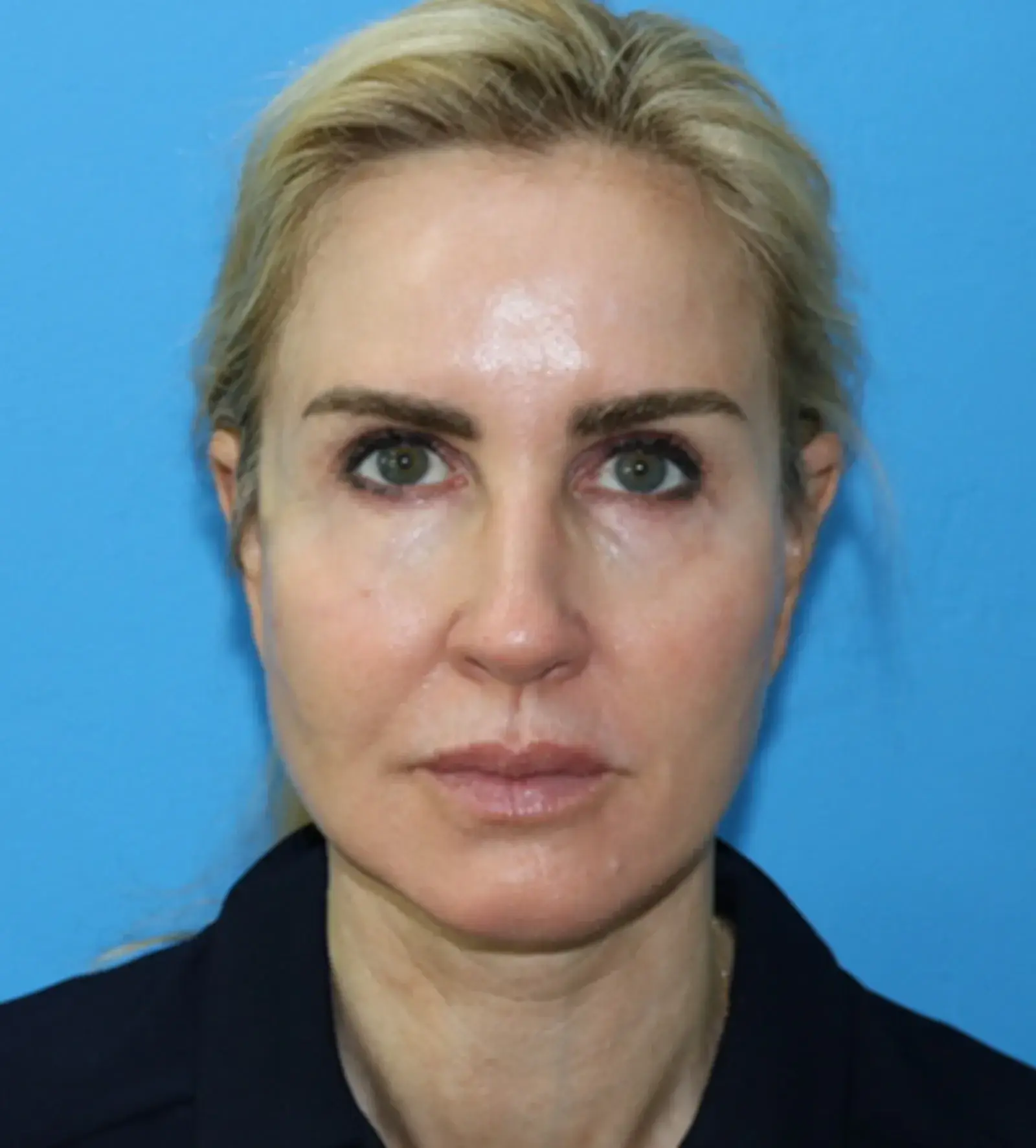 Moradi MD Cosmetic Surgery facelift after — Vista, CA