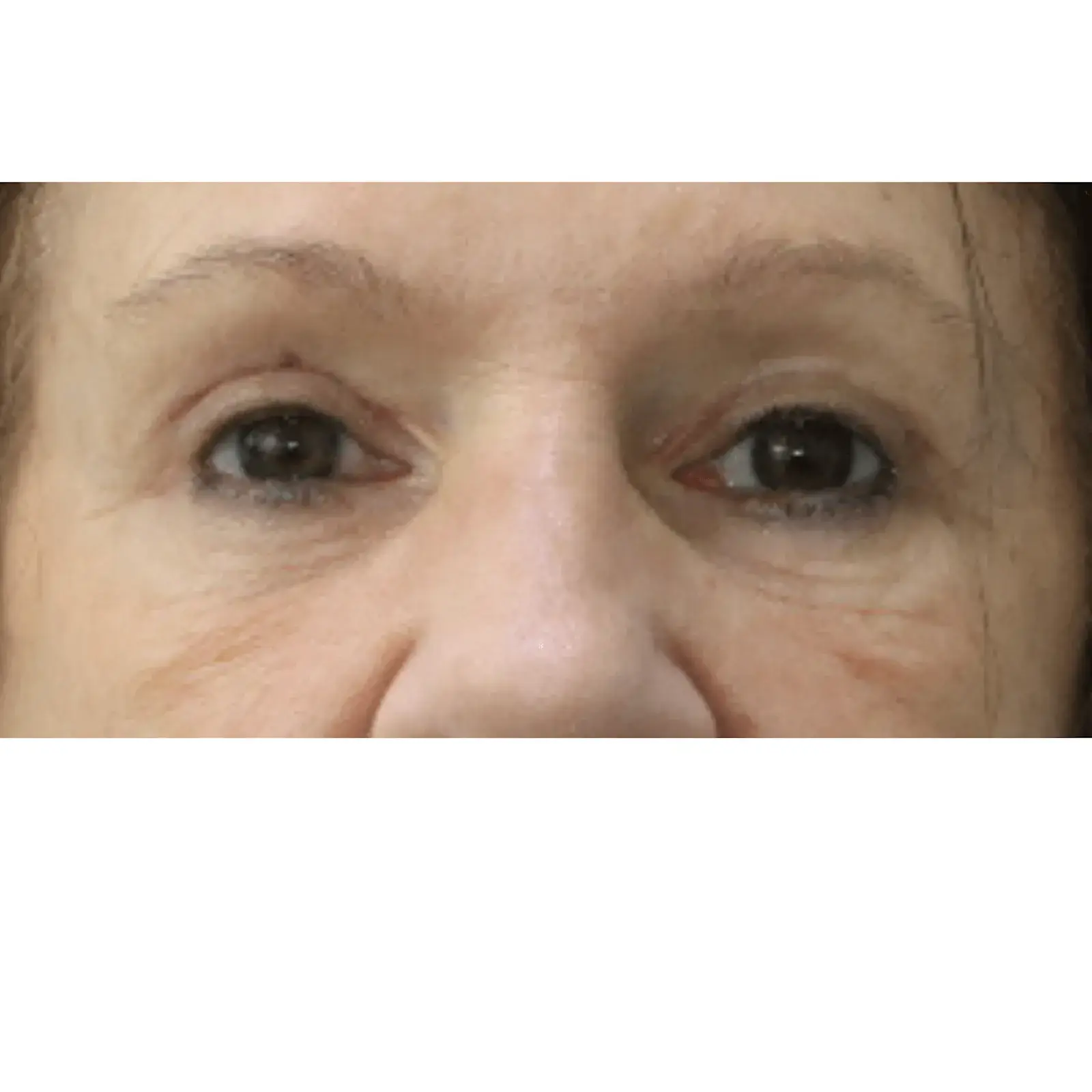 Moradi MD Cosmetic Surgery eyelid lift after — Vista, CA