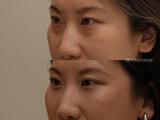 Blepharoplasty result at Dr. Grant Moore, MD in Scottsdale, AZ