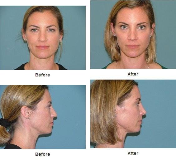 Estetica Institute of the Palm Beaches rhinoplasty result — Palm Beach Gardens, FL
