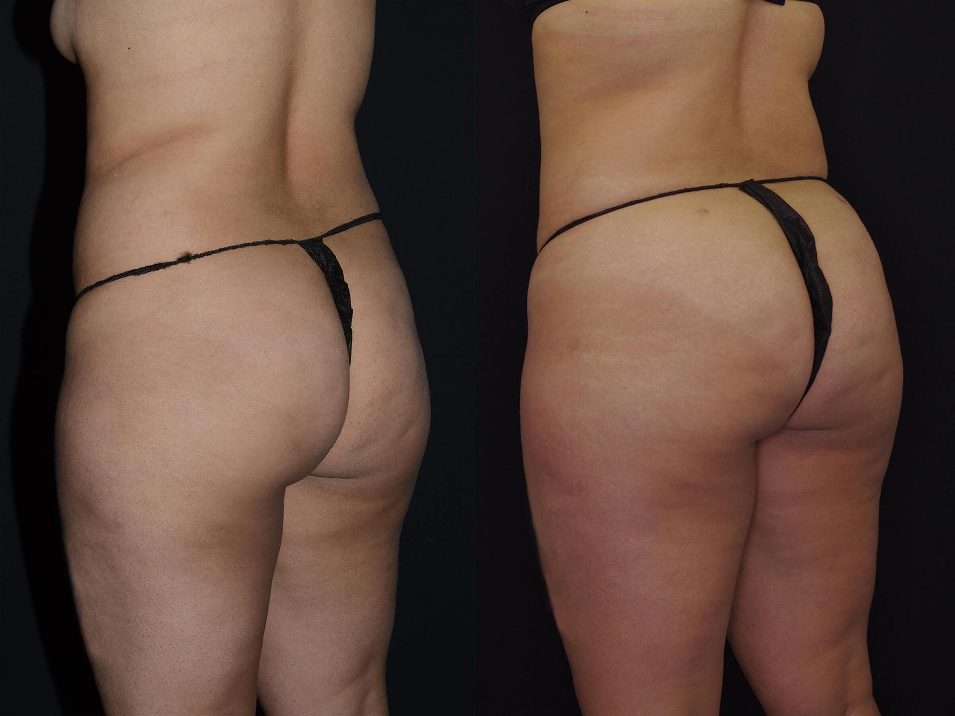 Estetica Institute of the Palm Beaches bbl result — Palm Beach Gardens, FL
