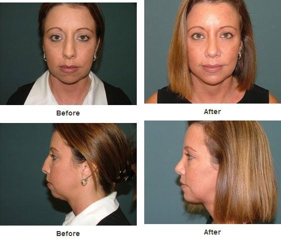 Estetica Institute of the Palm Beaches rhinoplasty result — Palm Beach Gardens, FL