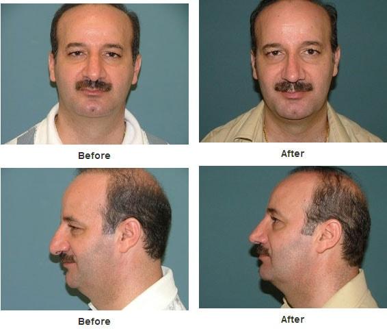 Estetica Institute of the Palm Beaches rhinoplasty result — Palm Beach Gardens, FL