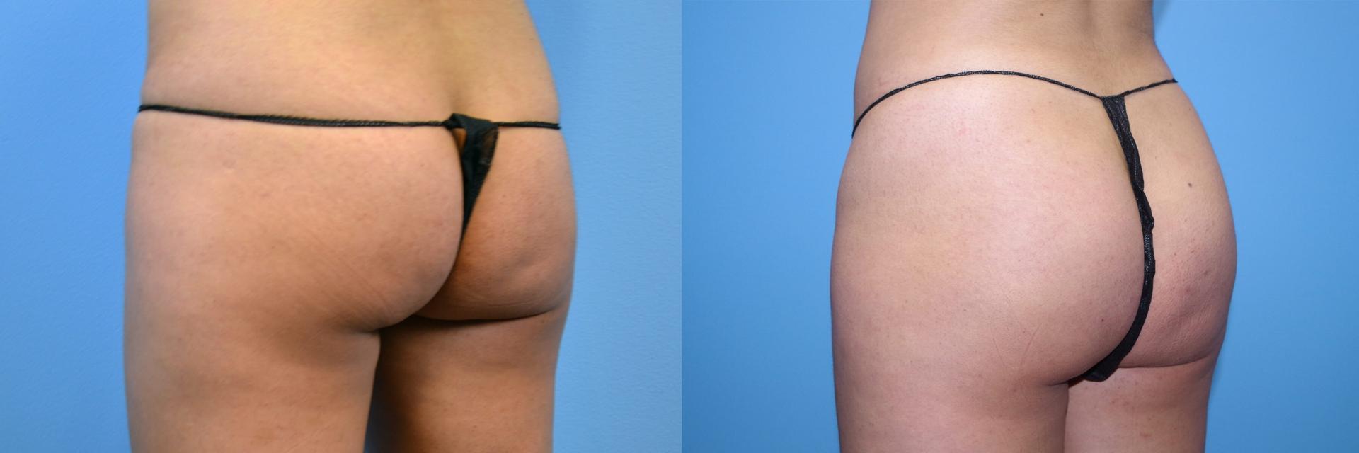 Estetica Institute of the Palm Beaches bbl result — Palm Beach Gardens, FL