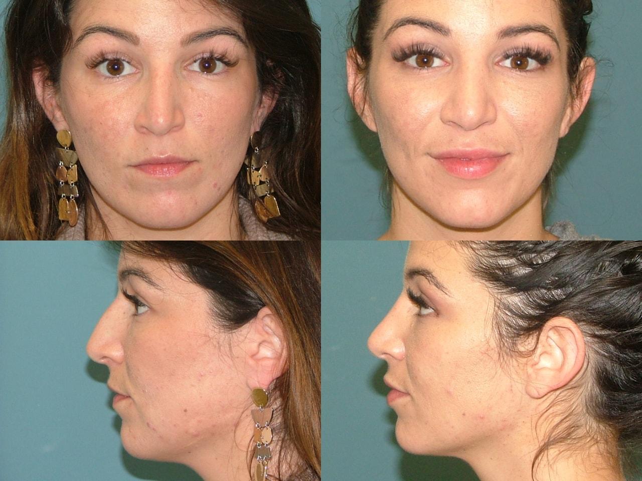 Estetica Institute of the Palm Beaches rhinoplasty result — Palm Beach Gardens, FL