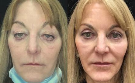 Kristin J. Tarbet, MD, FACS eyelid lift result — Bellevue, WA