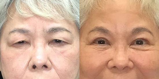 Kristin J. Tarbet, MD, FACS eyelid lift result — Bellevue, WA
