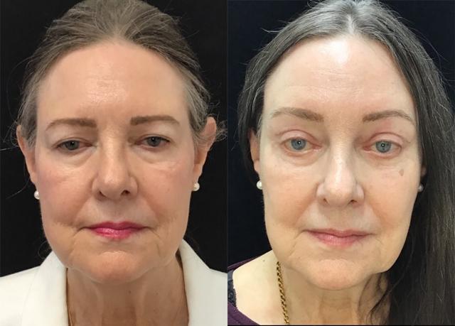 Brow Lift result at Kristin J. Tarbet, MD, FACS in Bellevue, WA