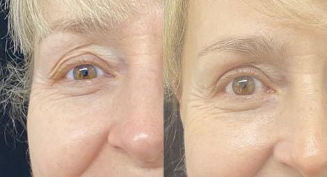 Morpheus8 result at Kristin J. Tarbet, MD, FACS in Bellevue, WA