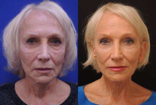 Dermal Fillers result at Kristin J. Tarbet, MD, FACS in Bellevue, WA