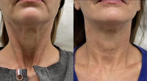Botox result at Kristin J. Tarbet, MD, FACS in Bellevue, WA